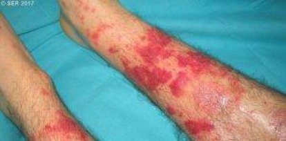 Púrpura palpable en piernas (vasculitis de hipersensibilidad). Foto cedida SER.
Autor: Dra. Mª Cristina Mata.,Púrpura palpable en piernas (vasculitis de hipersensibilidad). Foto cedida SER.
Autor: Dra. Mª Cristina Mata.