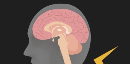 Ilustración de la estimulación del nervio vago.,Ilustración de la estimulación del nervio vago.