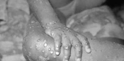 Todo lo que hay que saber sobre la viruela del mono,Todo lo que hay que saber sobre la viruela del mono