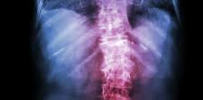 Espondilolistesis: Todo lo que debes saber sobre esta enfermedad,Espondilolistesis: Todo lo que debes saber sobre esta enfermedad