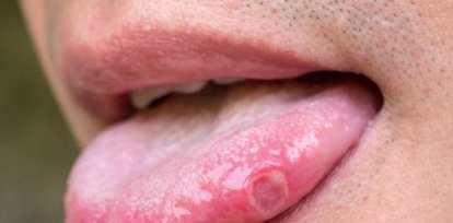 Lo que debe saber sobre las ETS y el sexo oral,Lo que debe saber sobre las ETS y el sexo oral