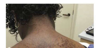 Día Mundial de la Sarcoidosis: ¿Qué es y cómo se cura?,Día Mundial de la Sarcoidosis: ¿Qué es y cómo se cura?