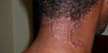 Día Mundial de la Sarcoidosis: ¿Qué es y cómo se cura?,Día Mundial de la Sarcoidosis: ¿Qué es y cómo se cura?