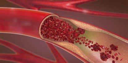 10 síntomas del cáncer que pueden pasar desapercibidos,10 síntomas del cáncer que pueden pasar desapercibidos