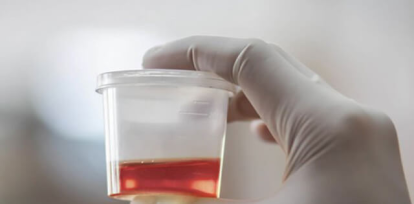 ¿Por qué los sobrevivientes orinaban negro en «La sociedad de la nieve»?,¿Por qué los sobrevivientes orinaban negro en «La sociedad de la nieve»?