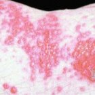 Herpes genital, una íntima pesadilla