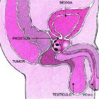 Descubren tarde cáncer próstata