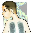 Tuberculosis infantil, otro<BR>rostro de la enfermedad