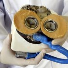 Implantan primer corazón artificial en la historia