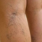 Varices.