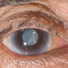 El 75 % de mayores de 70 años tendrán cataratas, alertan expertos