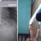 La imagen de rayos x mostró el cuchillo en la parte derecha del filipino.