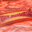 Vista de una arteria engrosada. Imagen ilustrativa.