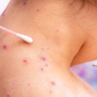 viruela del mono (Foto archivo).