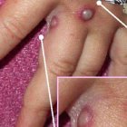 Viruela del mono en niños