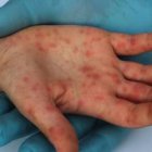 Viruela Símica: dan seguimiento a 7 personas sospechosas de contagio