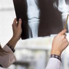 Osteoporosis