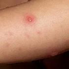 La varicela es estacional, dicen las autoridades.