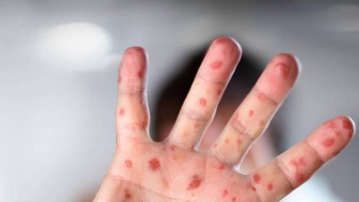 Persona con viruela del mono (Fuente externa)