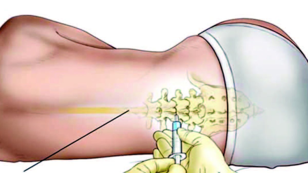 Para la punción lumbar se utiliza una aguja de aproximadamente 10 cm con mandri l .