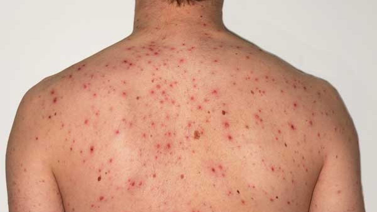 La viruela/Fuente externa