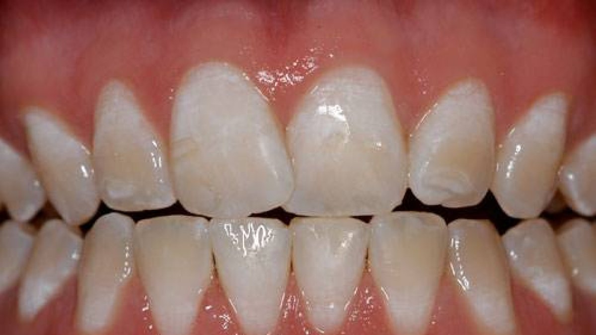 fluorosis foto