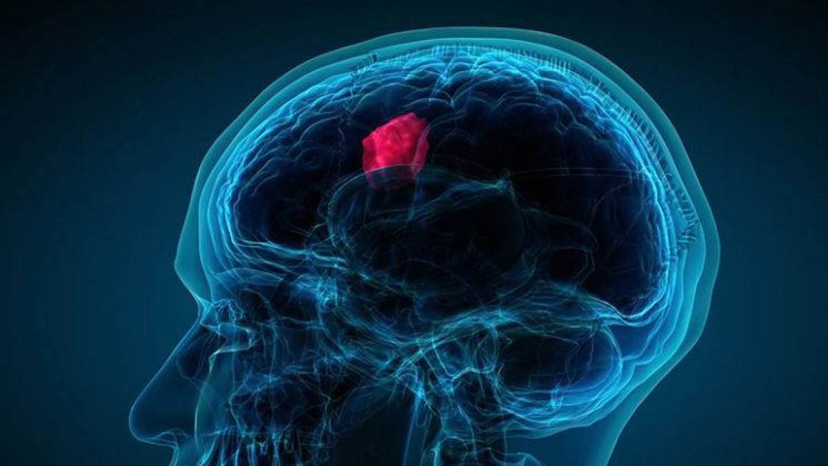 ¿Cuáles son las señales de advertencia reales de un tumor cerebral?-Fuente Externa.
