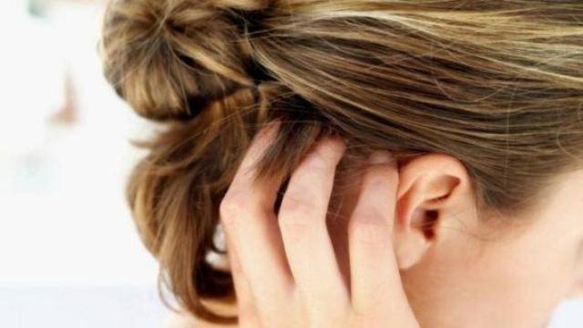 La caspa no tratada se asocia a la caída del cabello. Archivo.