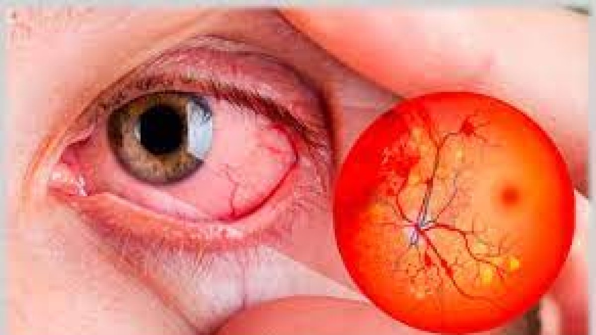 Especialista señala que un tercio de la población con diabetes tiene retinopatía diabética