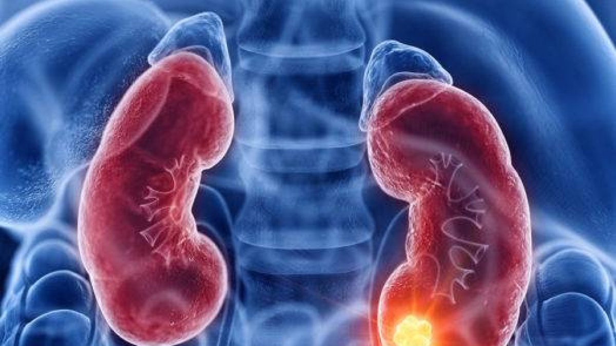 Día Mundial del Cáncer de Riñón: Los síntomas a lo que debe prestar ...