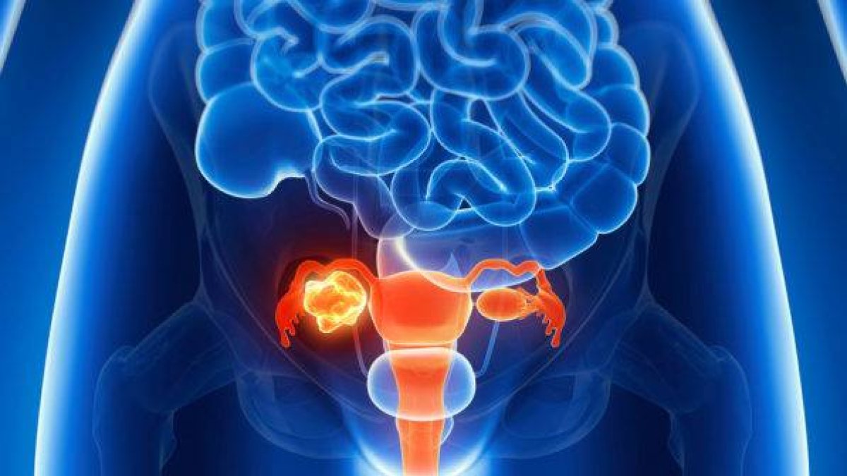 El costo económico del cáncer cervical: prevención vs. tratamiento
