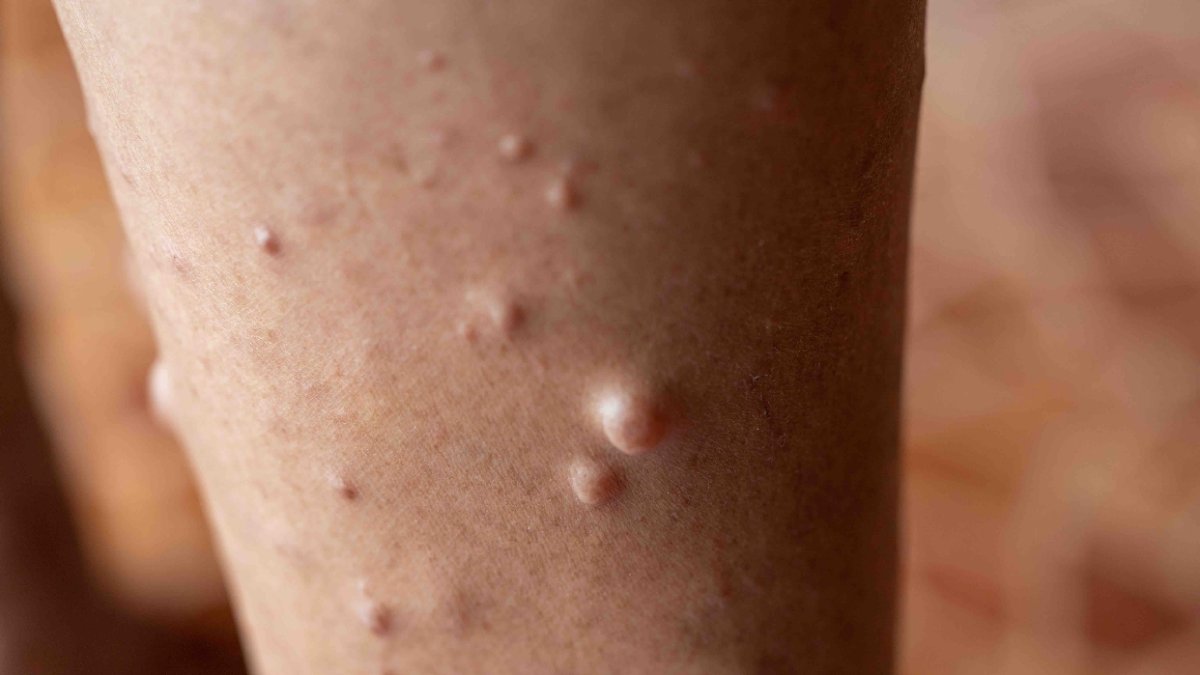 Se avanza en el tratamiento, pero falta la detección y diagnóstico temprano.