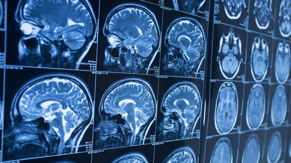 Diferencias entre Parkinson y temblor esencial: cómo identificar cada uno y cuándo acudir al médico