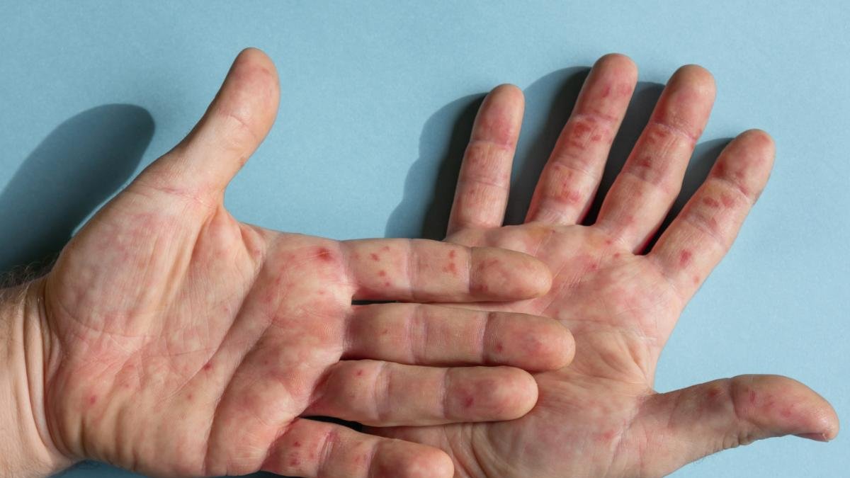 Lupus: una realidad enmascarada que desafía el diagnóstico