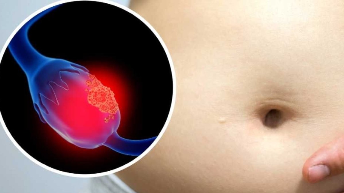Oncólogos sugieren detección temprana cáncer de ovario