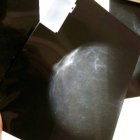 Cáncer de mama sigue con triste liderazgo