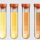 La orina puede adquirir tonos diferentes.