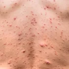 La viruela del mono no es un efecto secundario de la vacuna de la covid ni tiene relación con el herpes zóster