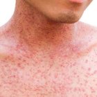 El sarampion es una enfermedad grave, altamente infecciosa y puede matar