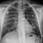 Nódulo pulmonar