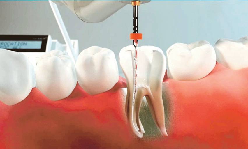 Implantes dentales