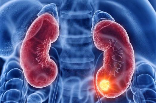 Día Mundial de Cáncer de Riñón.(Fuente externa)