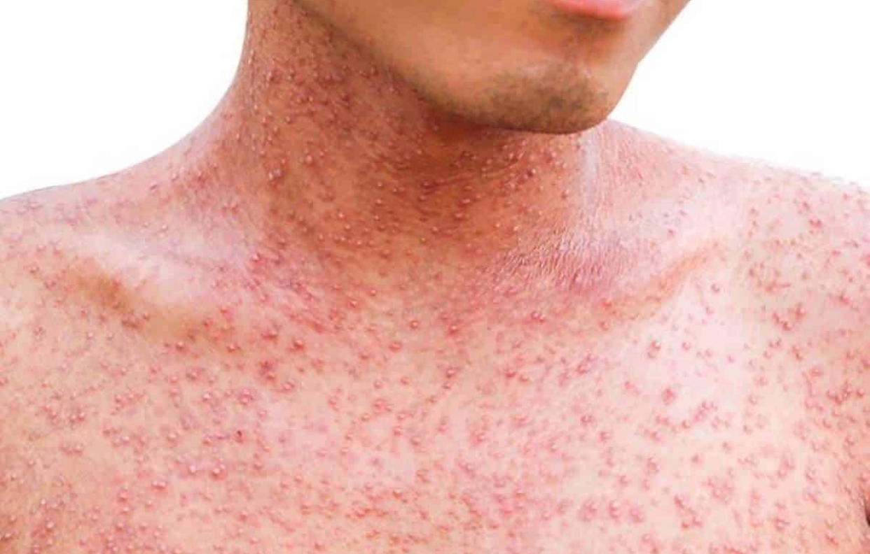 El sarampion es una enfermedad grave, altamente infecciosa y puede matar