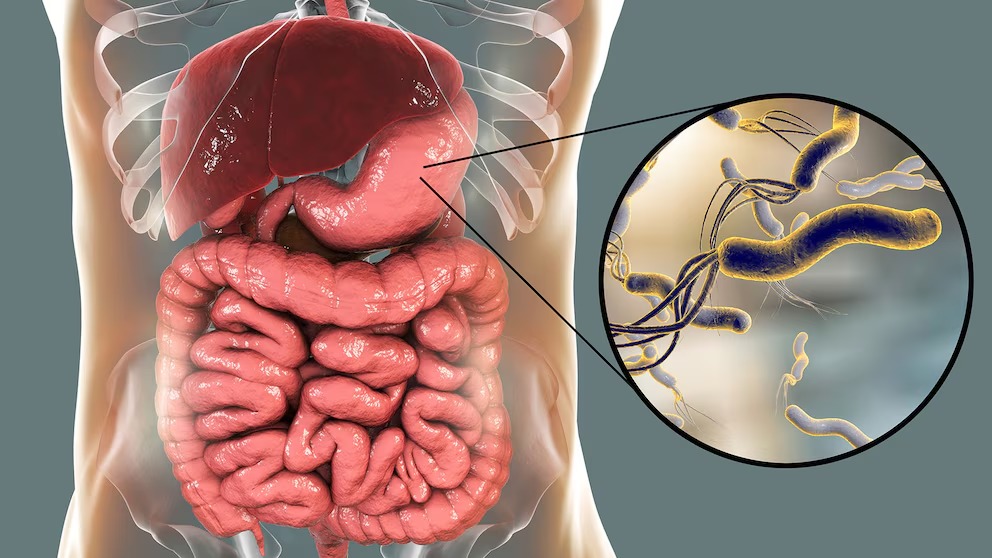 La bacteria Helicobacter pylori aumenta el riesgo de desarrollar úlceras, gastritis crónica e incluso cáncer de estómago (Shutterstock)