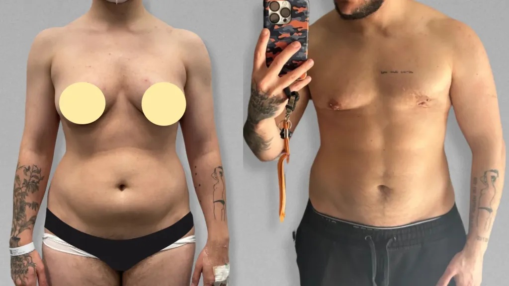 Resultados finales de una LipoSculpt 4D realizada por la Dra. Christina Brasso. Foto cedida por Clínica Brasó.