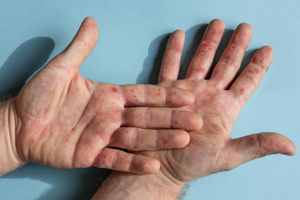 Lupus