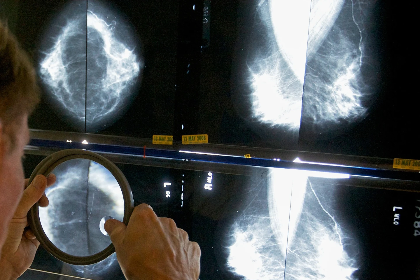 Un radiólogo utiliza una lupa para examinar mamografías en busca de cáncer de mama en Los Ángeles, el 6 de mayo de 2010. (Foto AP/Damian Dovarganes, archivo)