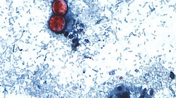 La ciclosporosis es una enfermedad intestinal causada por el parásito Cyclospora cayetanensis