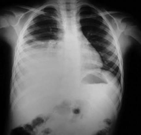 Los reportes e hipótesis preliminares apuntan a que la exposición letal al agente infeccioso (relacionado con la bacteria Yersinia pestis